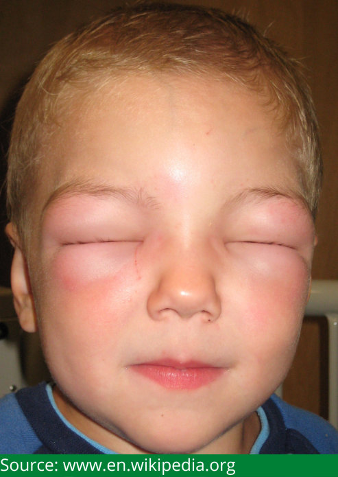 Angioedema