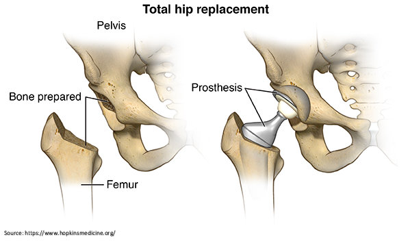 . Total hip replacement