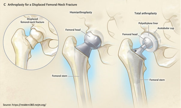 Partial hip replacement