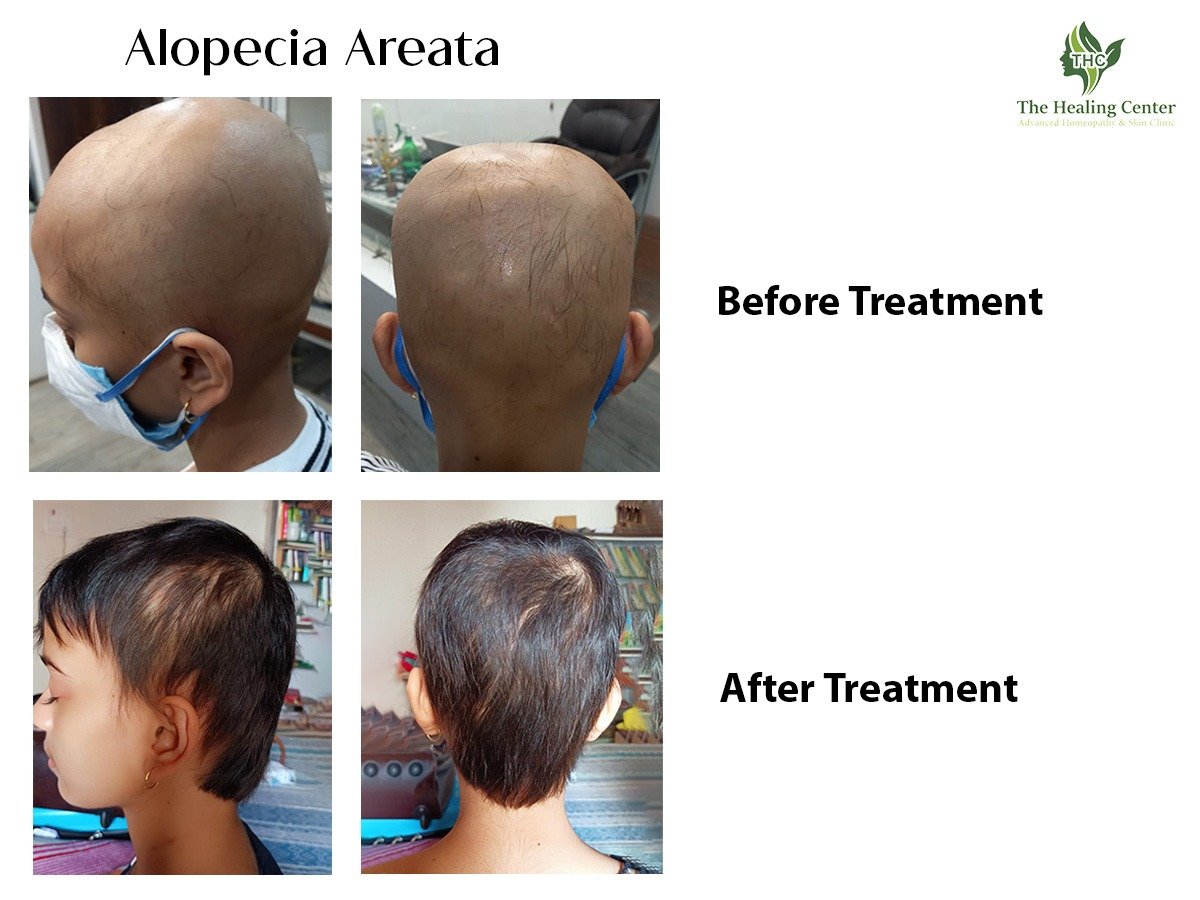 alopecia totalis