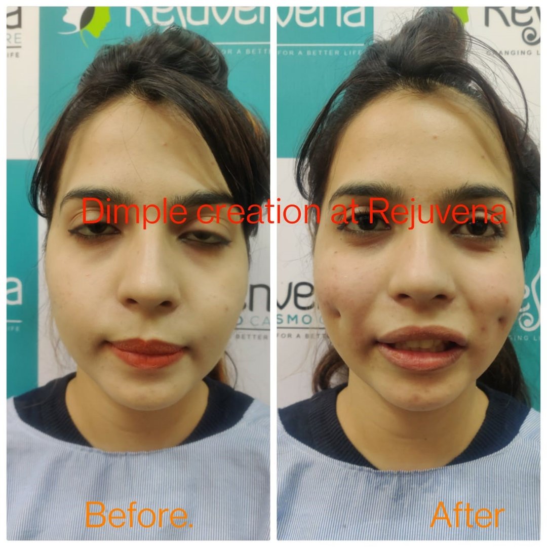 Dimple Creation In Jaipur Rejuvena Cosmo Care