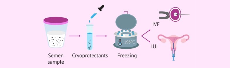 cryopreservation (Egg freezing)