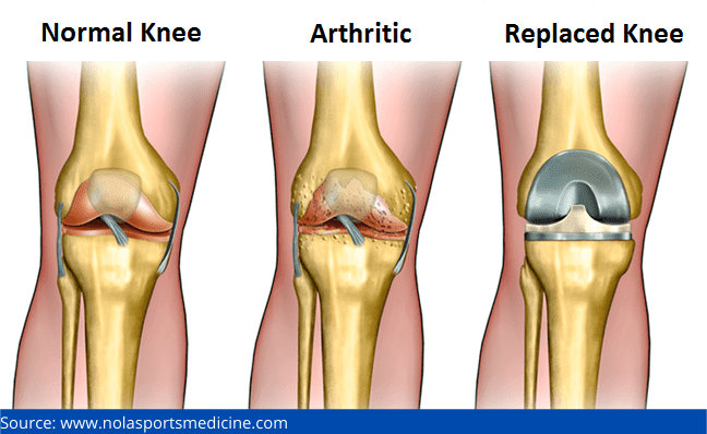 Knee replacement