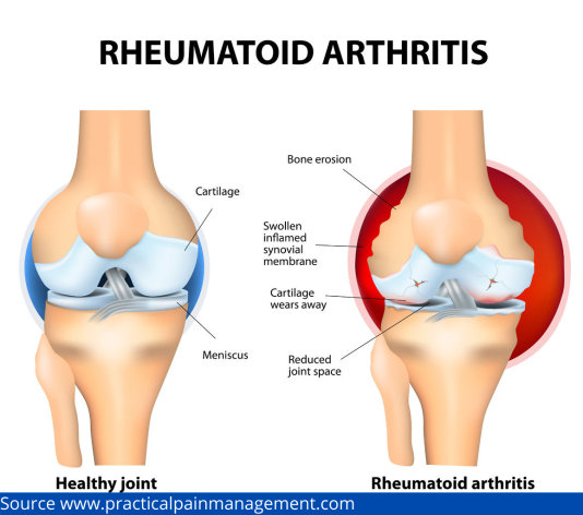 Rheumatoid Arthritis