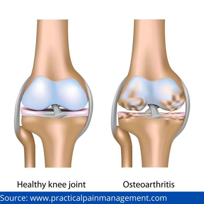 Osteoarthritis