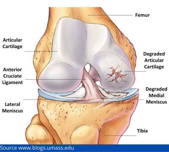 Post-traumatic arthritis