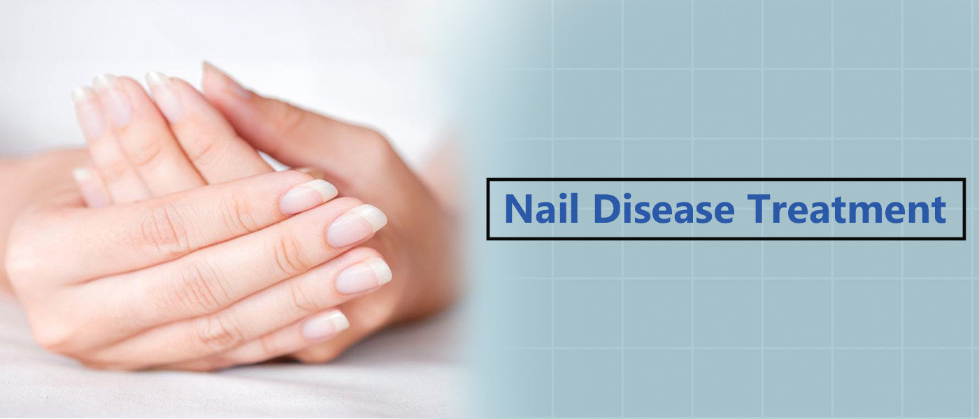 Nail Disease Treatment in Faridabad - View Cost | KDC Clinic