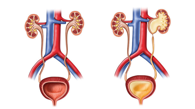 Ureteropelvic Junction (UPJ) Obstruction | Children's Hospital of Philadelphia