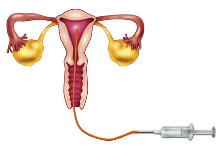Frozen Embryo Transfer (FET)