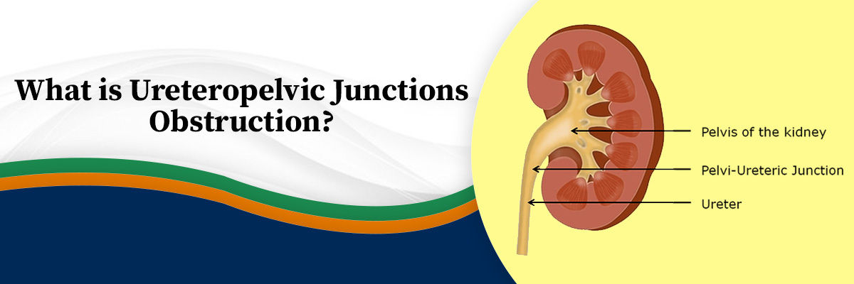 Ureteropelvic Junctions Obstruction