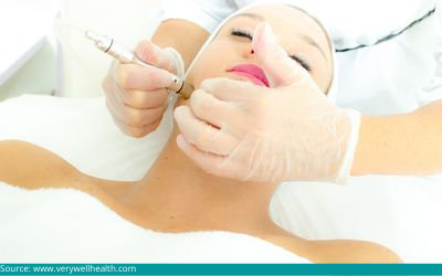  microdermabrasion