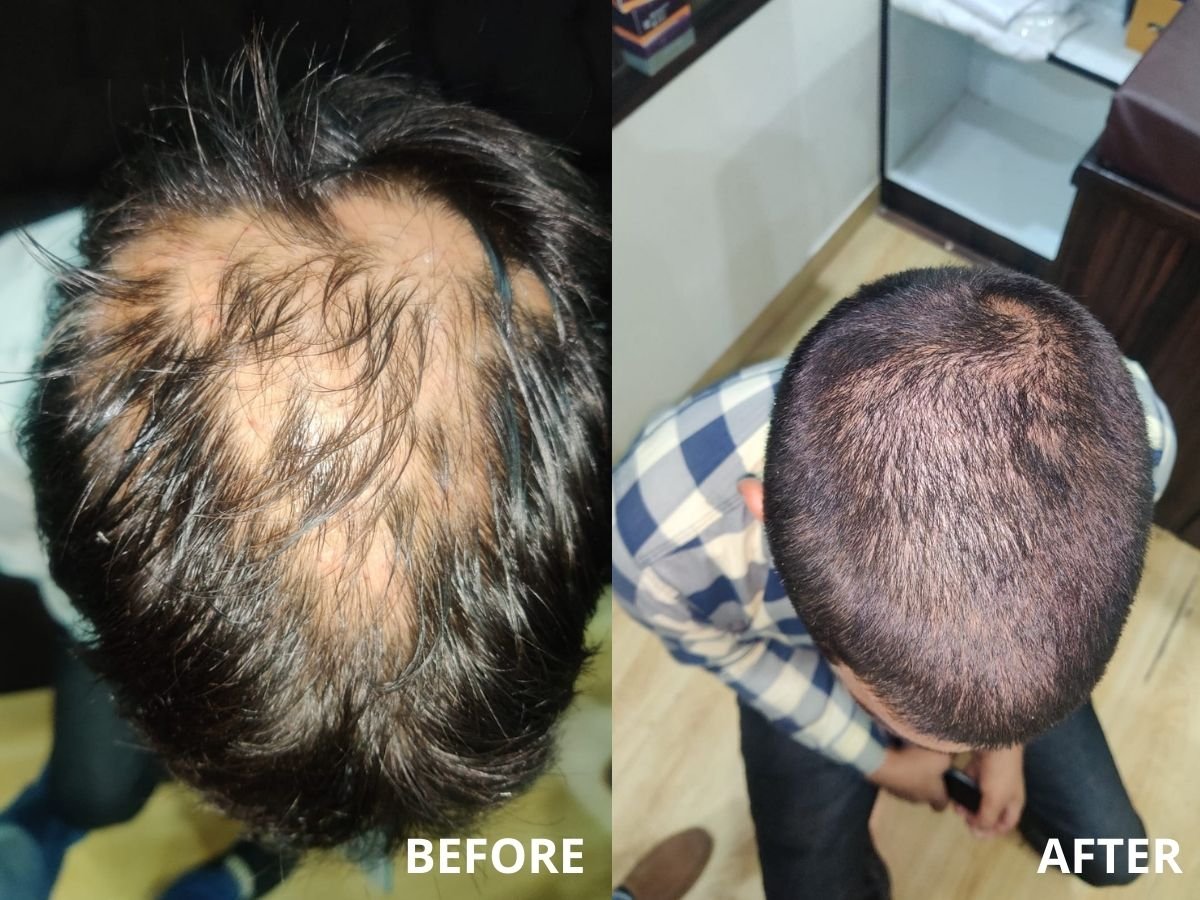 Near complete hair regrowth after receiving three PRP injections As   Download Scientific Diagram