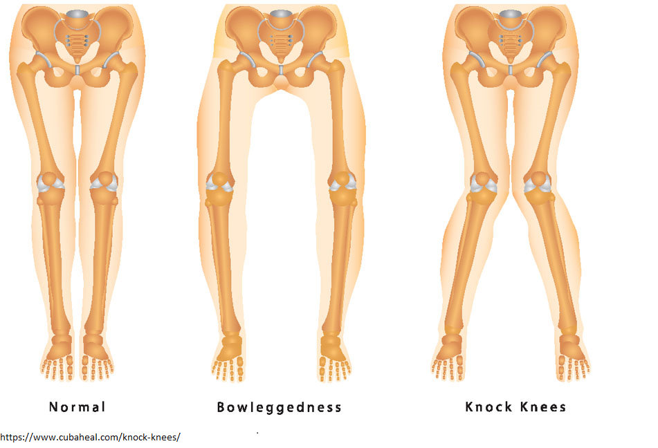 Knee deformities 