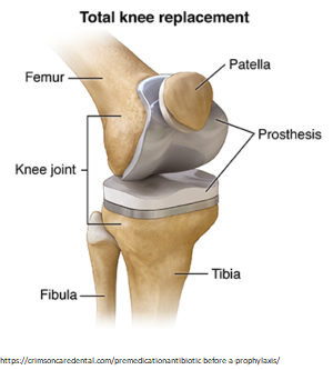 Knee Replacement