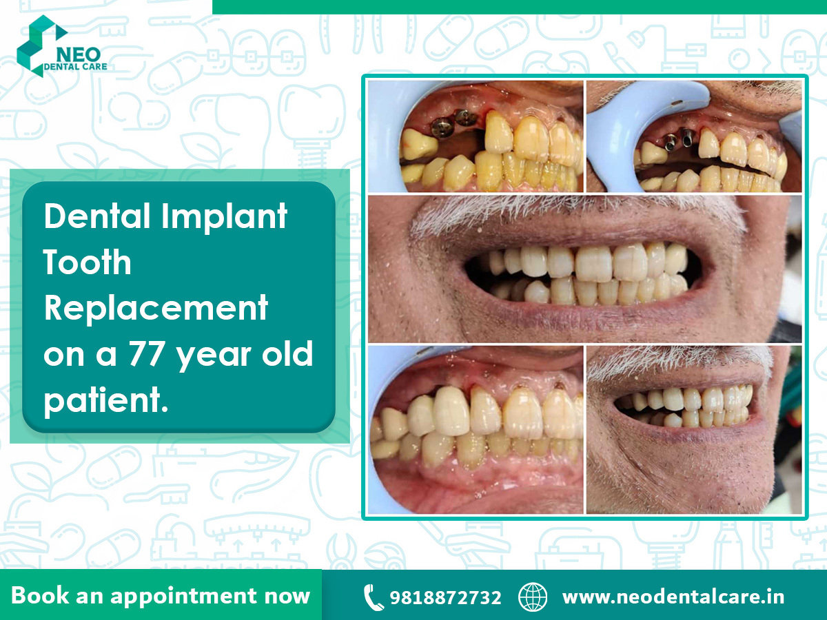 Neo_Dental_Dental_Implant_on_a_77yr_old_patient Neo_Dental_Dental_Implant_on_a_77yr_old_patient