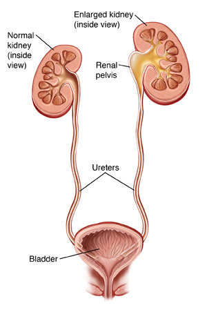 Ureteropelvic junction obstruction