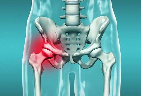 Hip Replacement