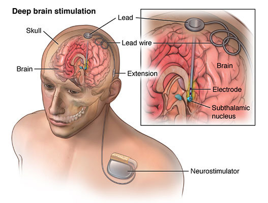 Deep Brain Stimulation
