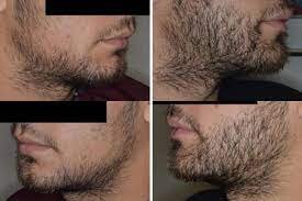 Beard Transplants | Miami, FL | Dr. Anthony Bared