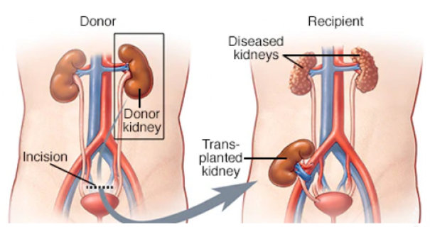 Renal Transplant