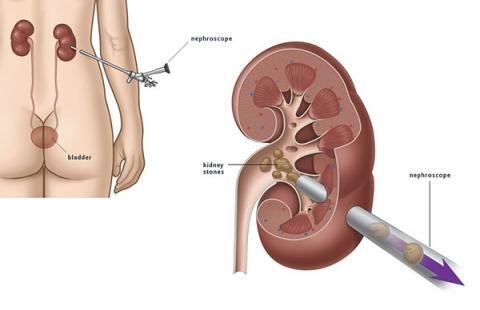 PCNL Surgery