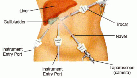 Laparoscopic Nephrectomy