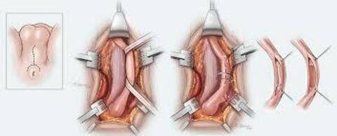 Urethroplasty Surgery