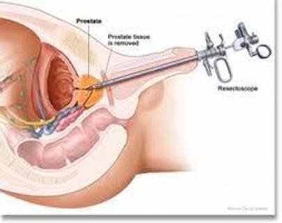 Endourological Procedures