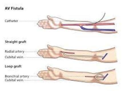 AV Fistula for Dialysis