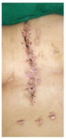 After Wound Healing