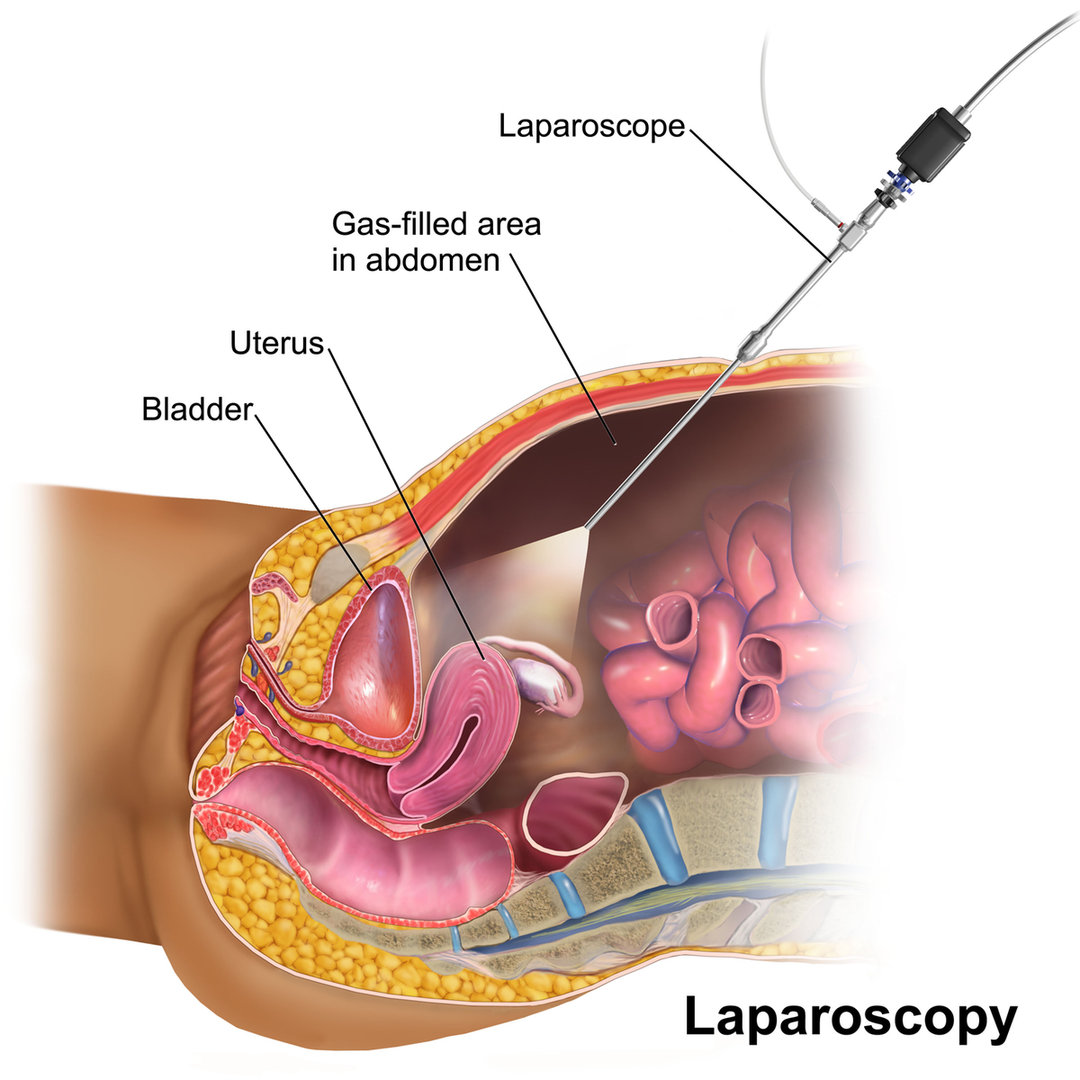 Laparoscopic surgery