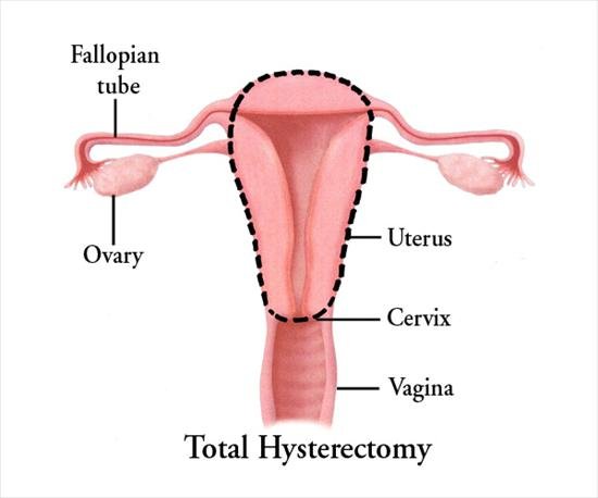 Hysterectomy