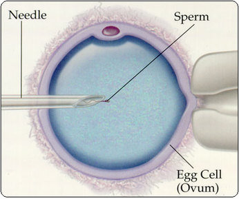 Assisted Reproductive Technologies