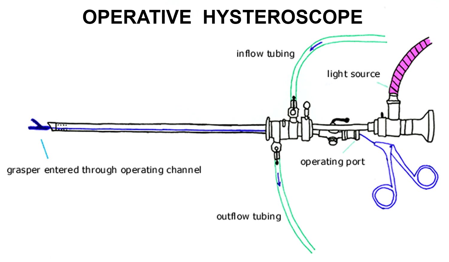 Operative hysteroscopy treatment