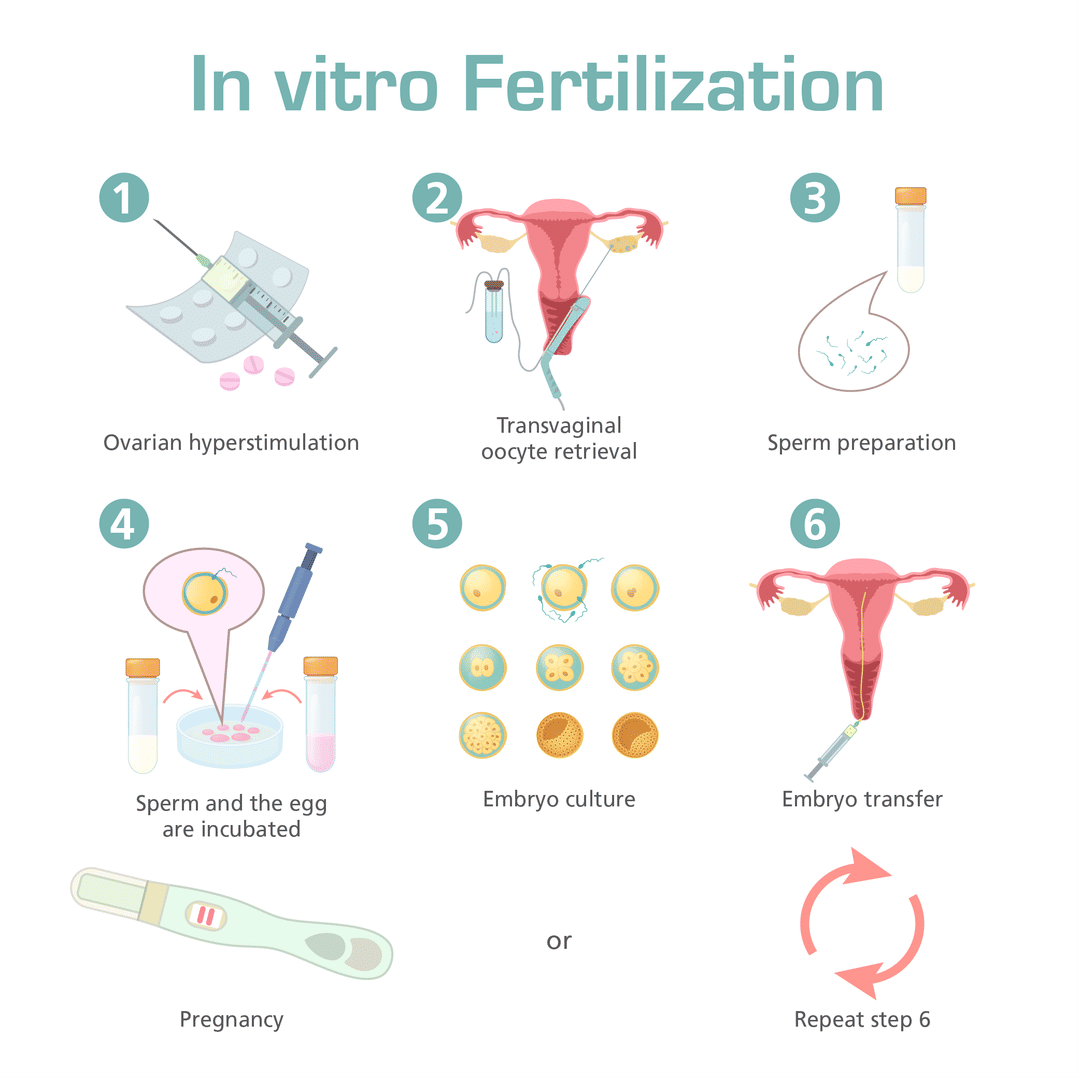 IVF Overview