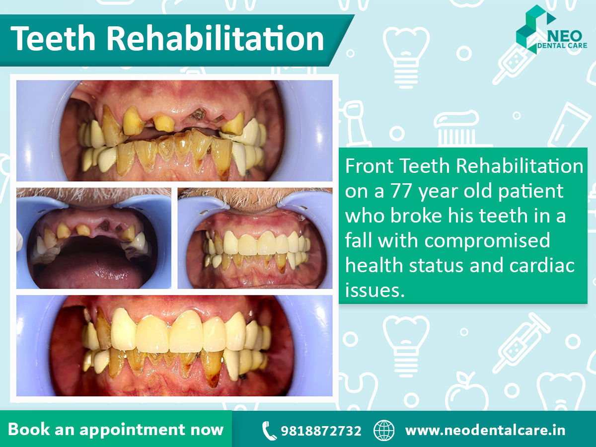 Front Tooth Rehabilitation of a 77 year old Patient