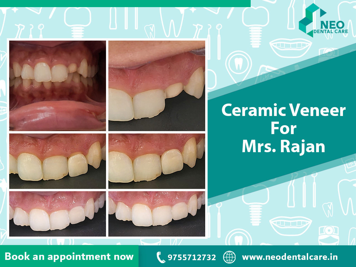 Ceramic Veneers Ceramic Veneers