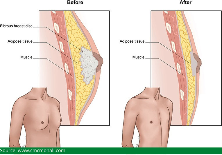 treatment for gynecomastia