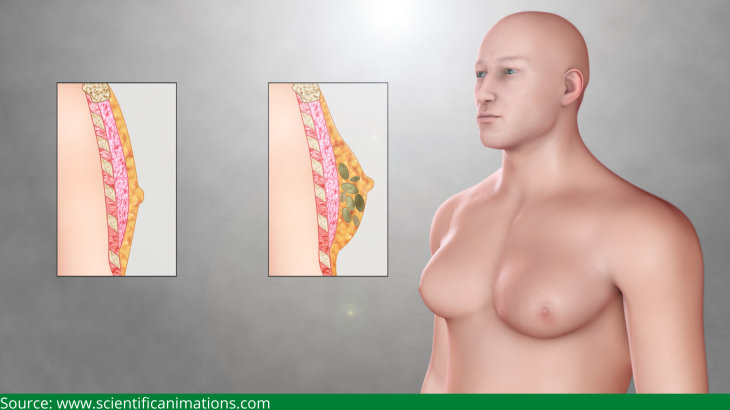 Gynecomastia