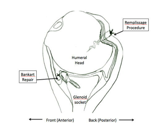 Treatment of Recurrent Anterior Shoulder Instability | Boston Shoulder Institute