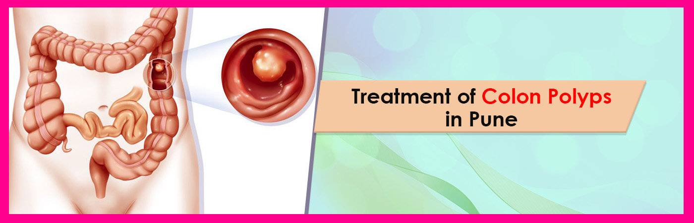 symptoms of colon polyps symptoms of colon polyps