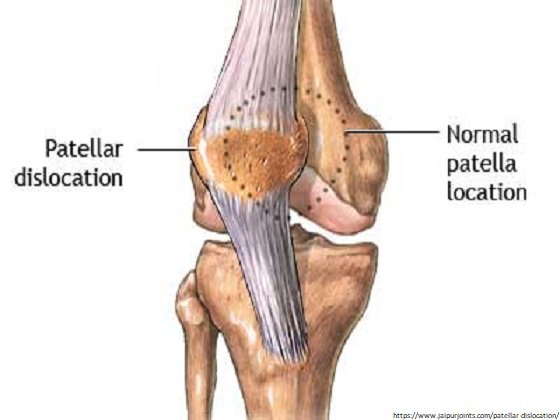 Recurrent patellar dislocations