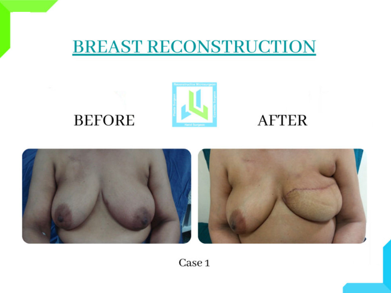 Breast Reconstruction Breast Reconstruction