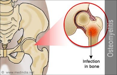 osteomyelitis