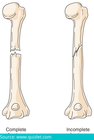 The Causes, Types, Symptoms And Treatment Of Bone Fractures