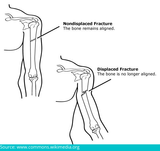  non-displaced fractures