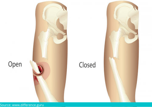 Open and closed fractures
