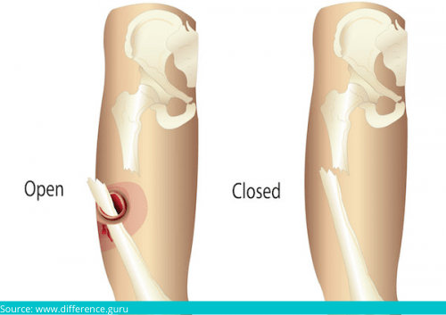 The Causes Types Symptoms And Treatment Of Bone Fractures