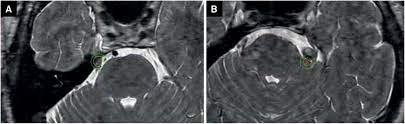 Gamma Knife® Radiosurgery for Trigeminal Neuralgia