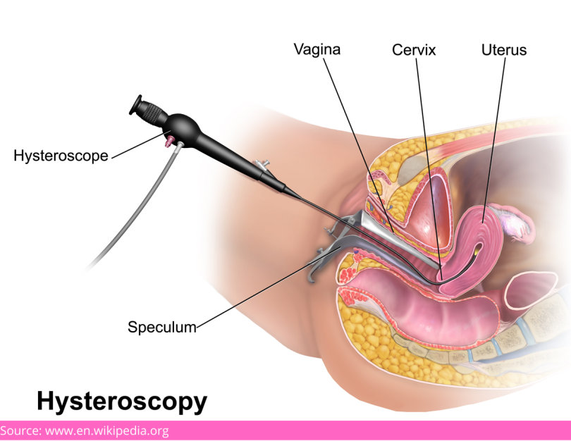 hysteroscopy  procedure in mumbai